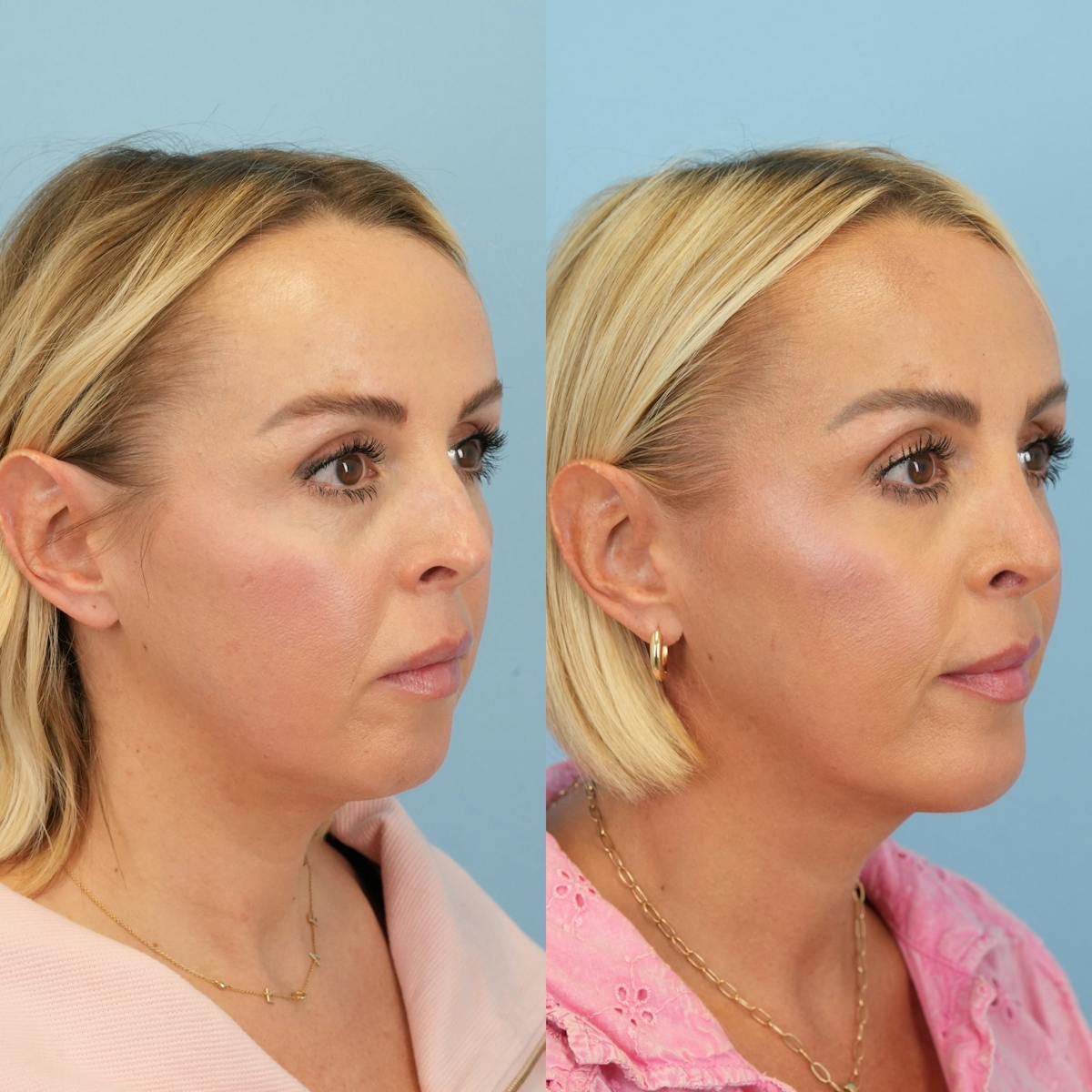 Rhinoplasty Before & After Gallery - Patient 137056 - Image 2