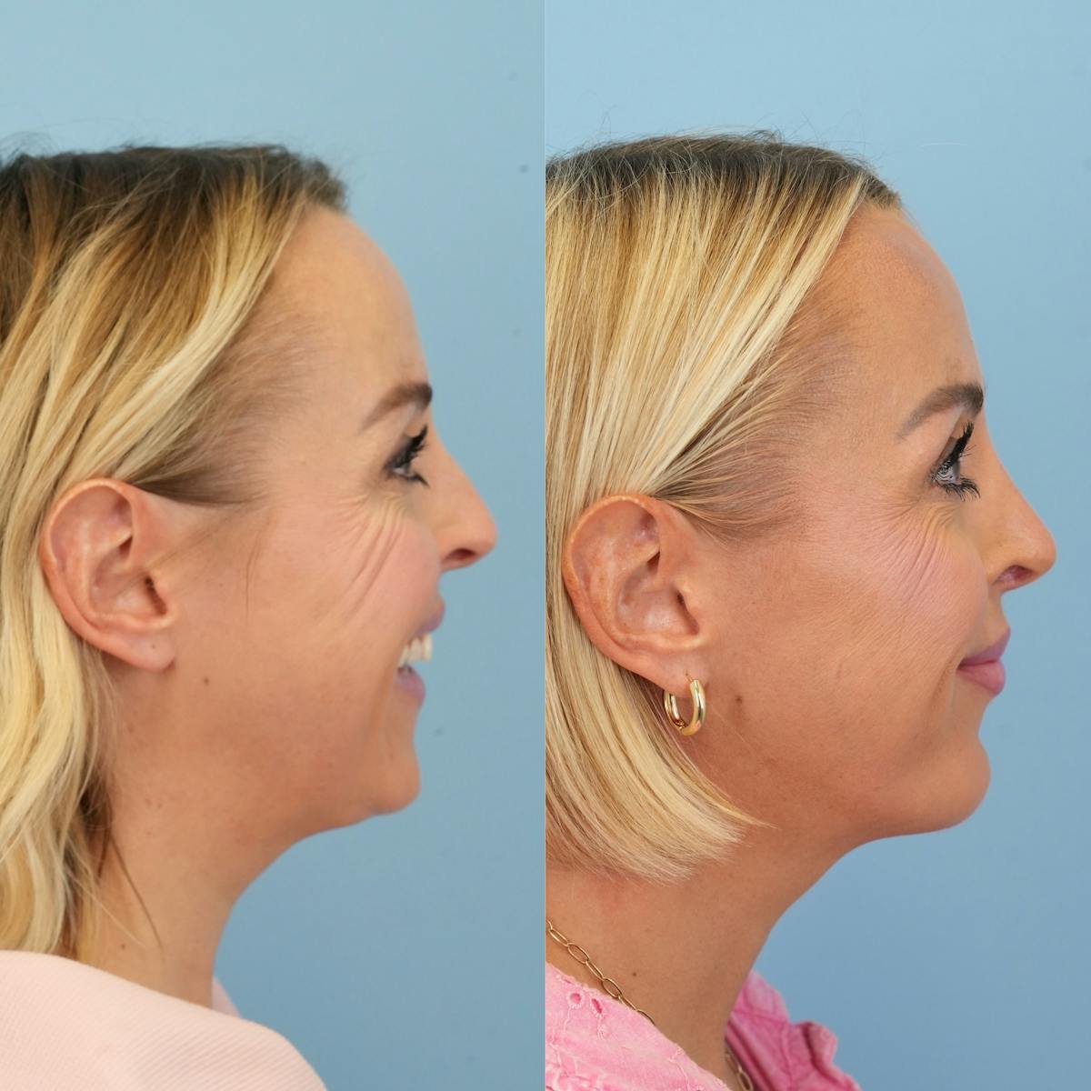 Rhinoplasty Before & After Gallery - Patient 137056 - Image 4