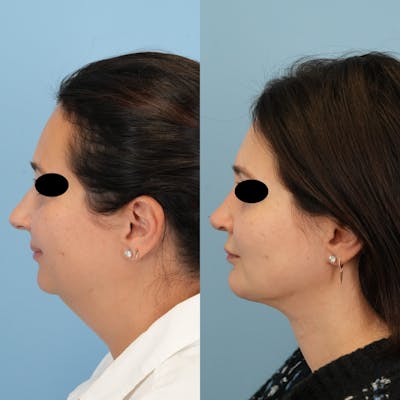Chin Implants Before & After Gallery - Patient 122066 - Image 1