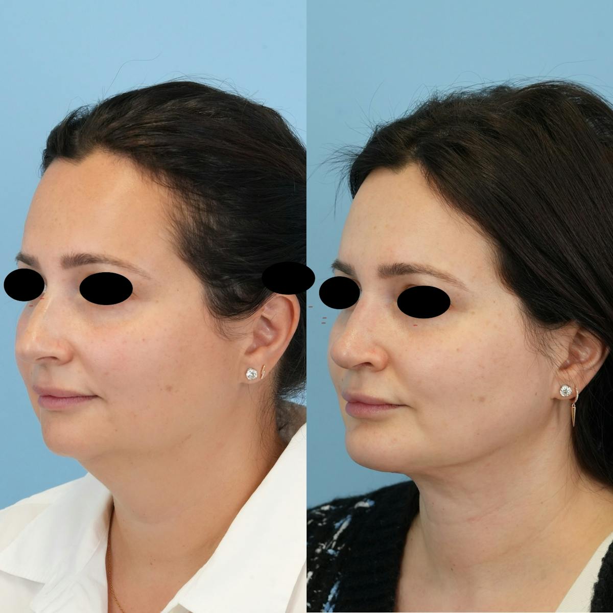 Chin Implants Before & After Gallery - Patient 122066 - Image 2