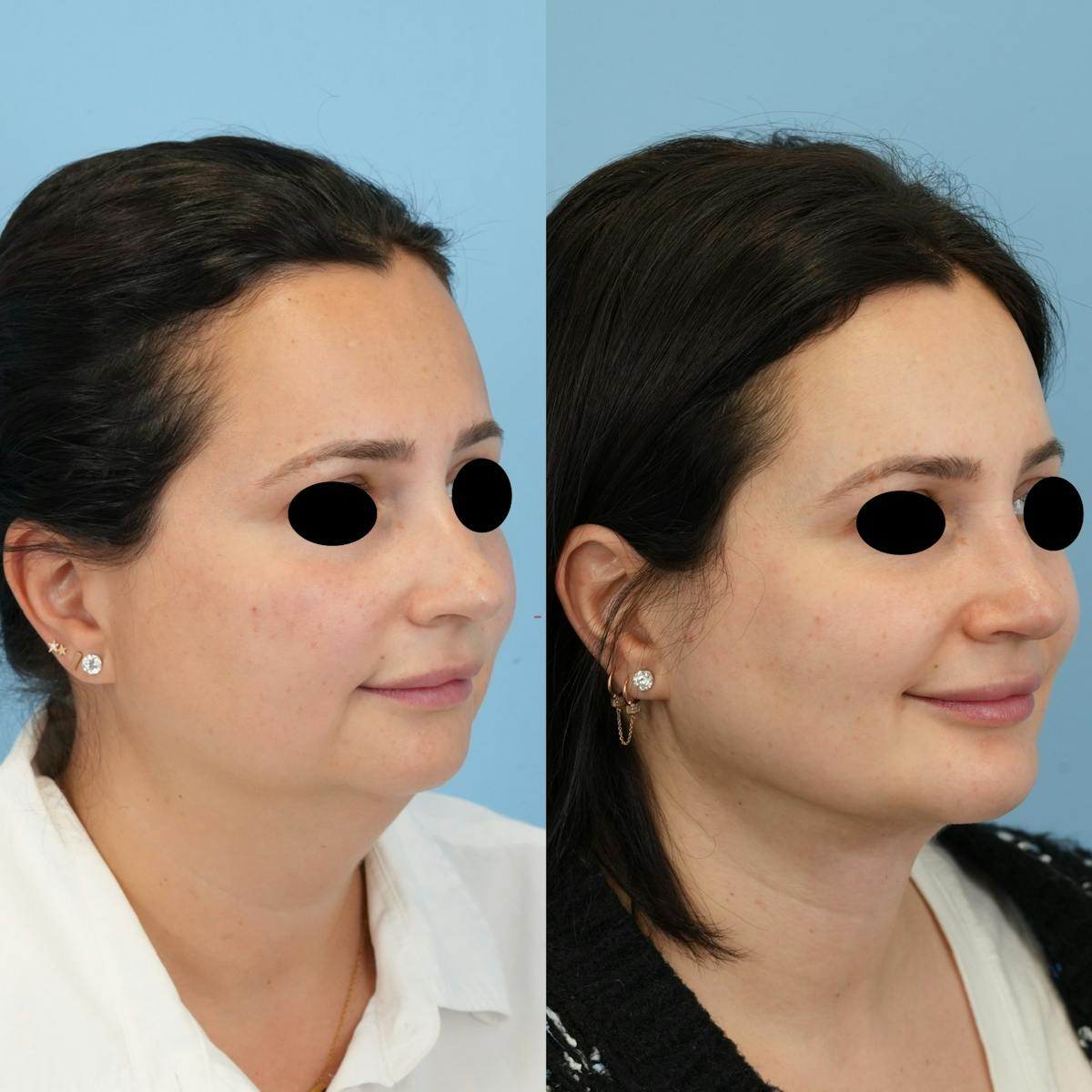 Chin Implants Before & After Gallery - Patient 122066 - Image 4
