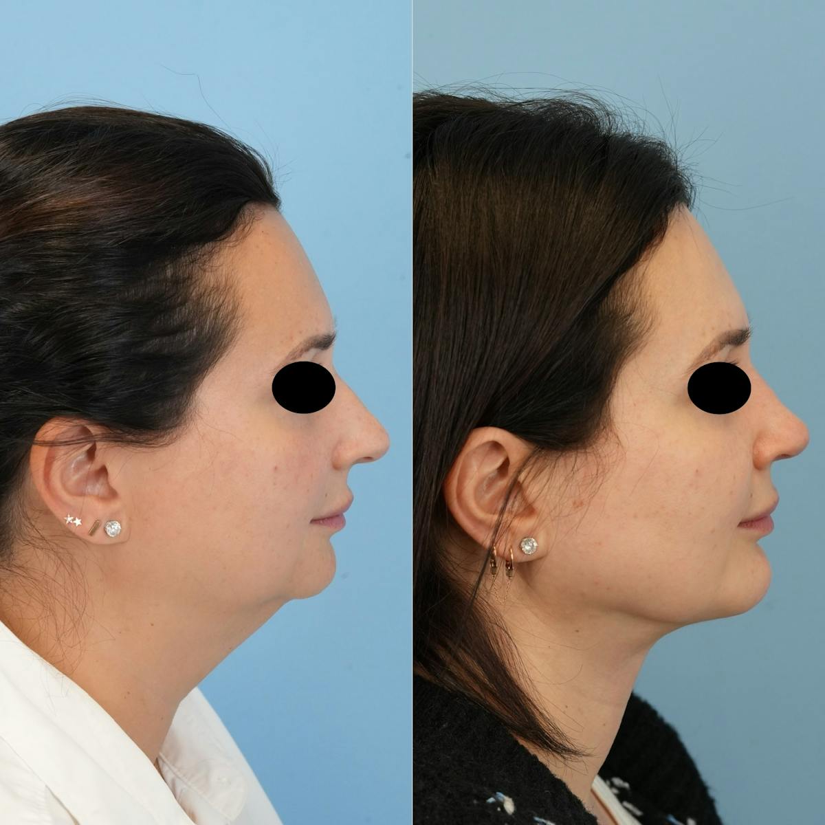 Chin Implants Before & After Gallery - Patient 122066 - Image 5