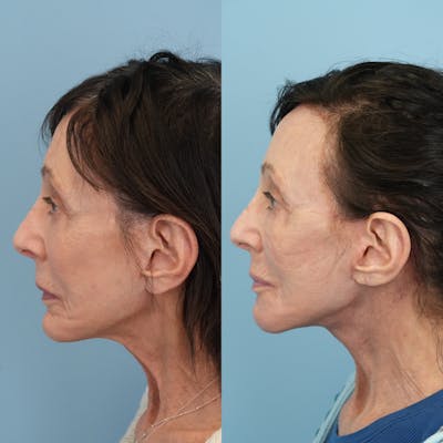 Chin Implants Before & After Gallery - Patient 320505 - Image 1