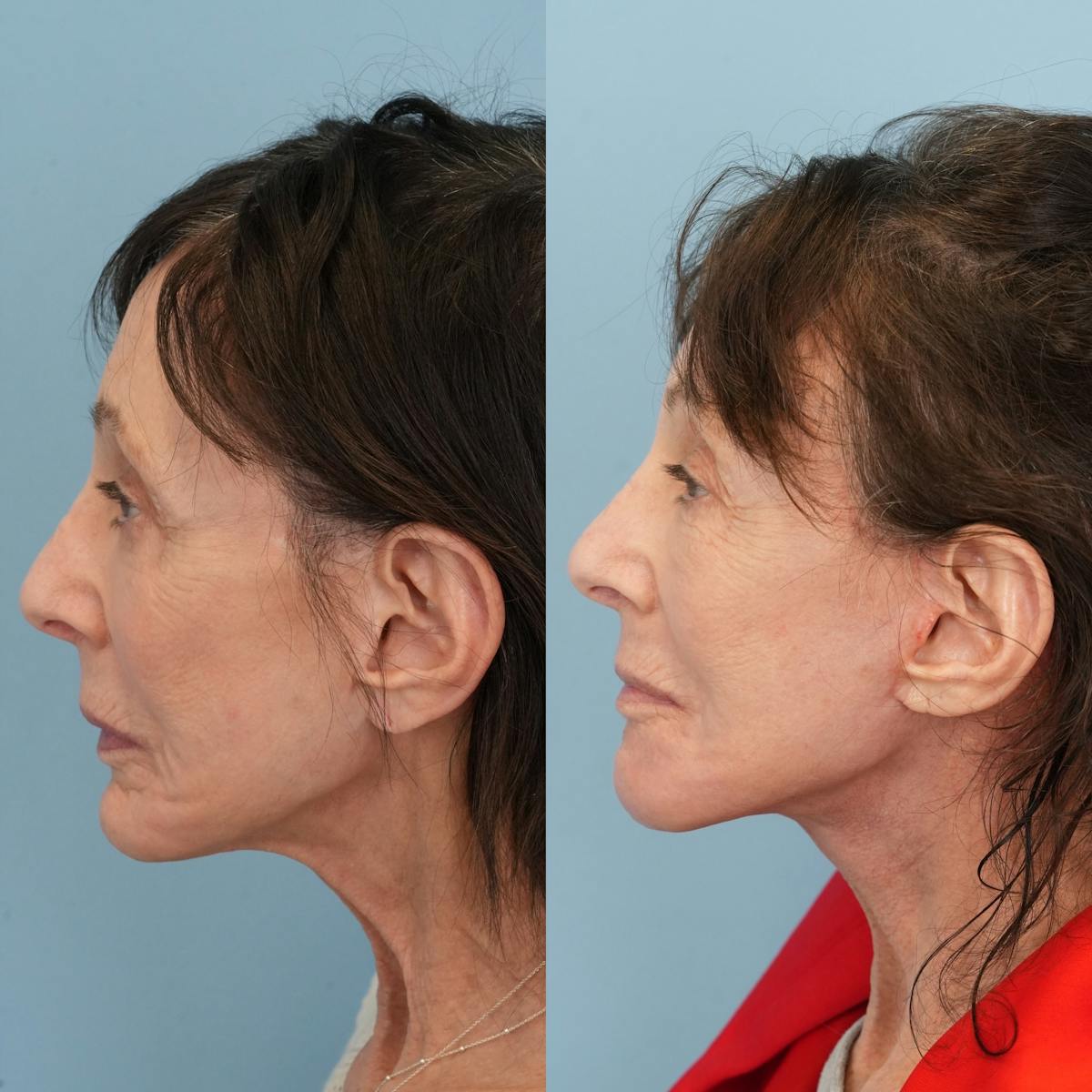 Chin Implants Before & After Gallery - Patient 320505 - Image 2