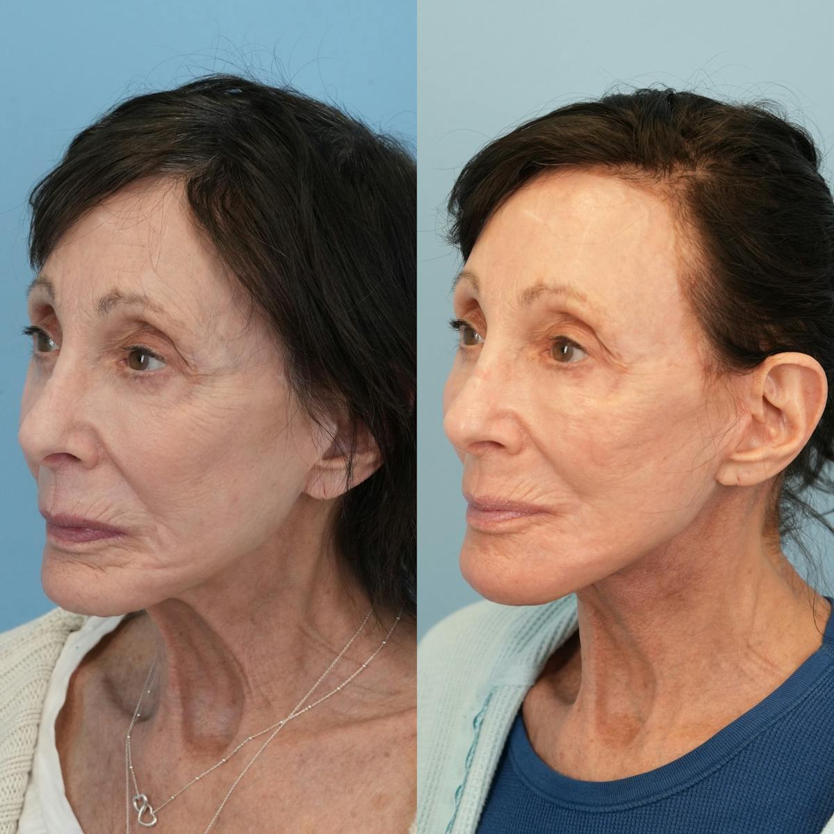 Chin Implants Before & After Gallery - Patient 320505 - Image 3