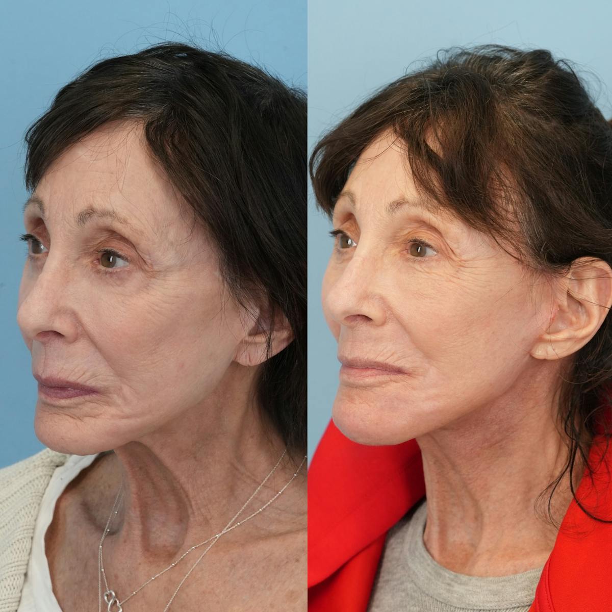 Chin Implants Before & After Gallery - Patient 320505 - Image 4