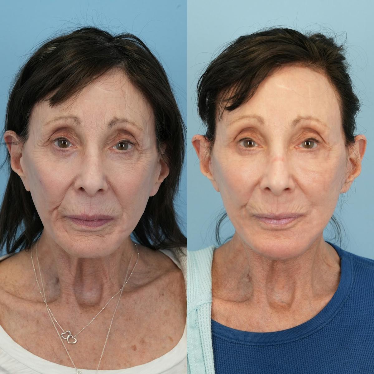 Chin Implants Before & After Gallery - Patient 320505 - Image 5