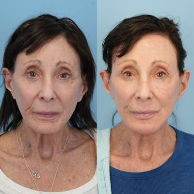 Facelift Before & After Gallery - Patient 453028 - Image 1