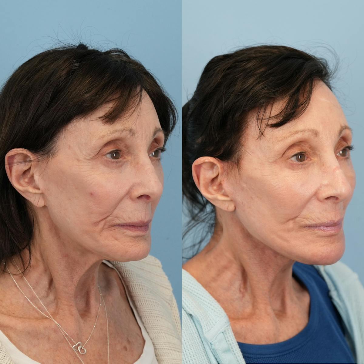 Chin Implants Before & After Gallery - Patient 320505 - Image 7