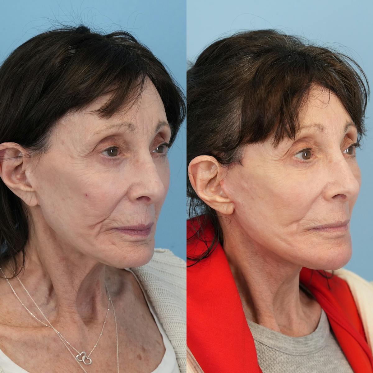 Chin Implants Before & After Gallery - Patient 320505 - Image 8