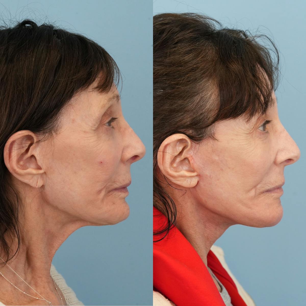 Chin Implants Before & After Gallery - Patient 320505 - Image 10