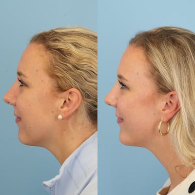 Chin Implants Before & After Gallery - Patient 377766 - Image 1