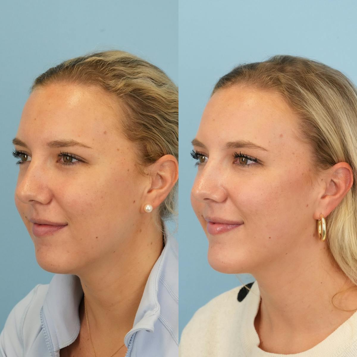 Chin Implants Before & After Gallery - Patient 377766 - Image 2