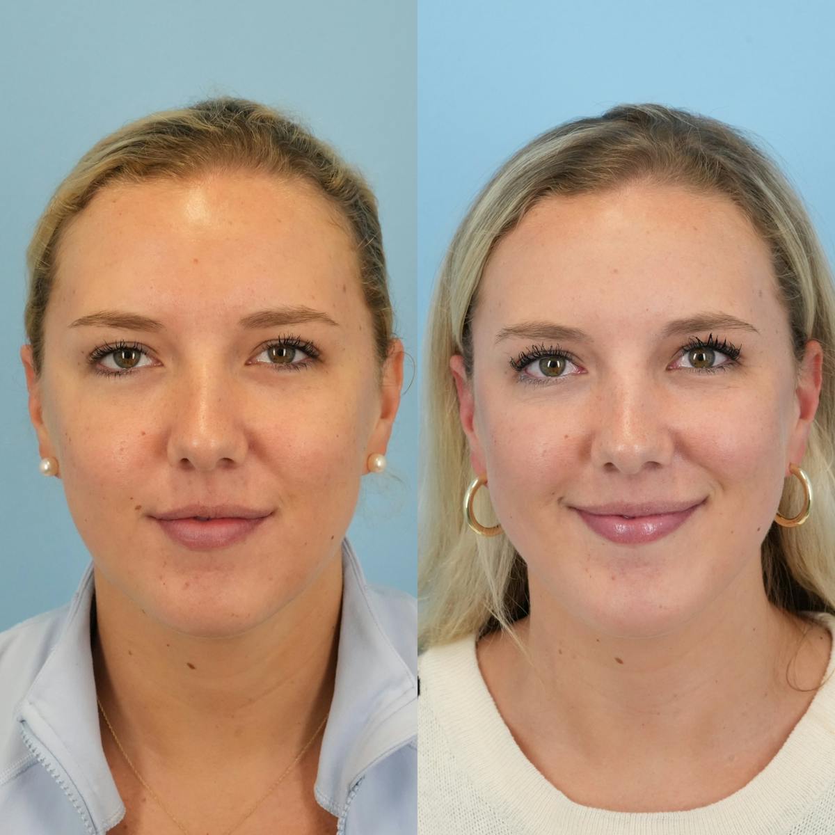 Chin Implants Before & After Gallery - Patient 377766 - Image 3