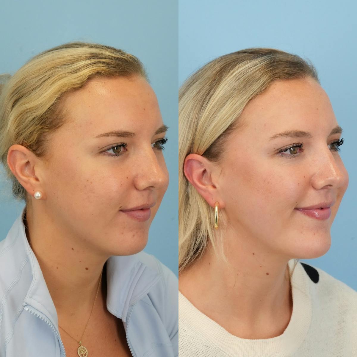 Chin Implants Before & After Gallery - Patient 377766 - Image 4