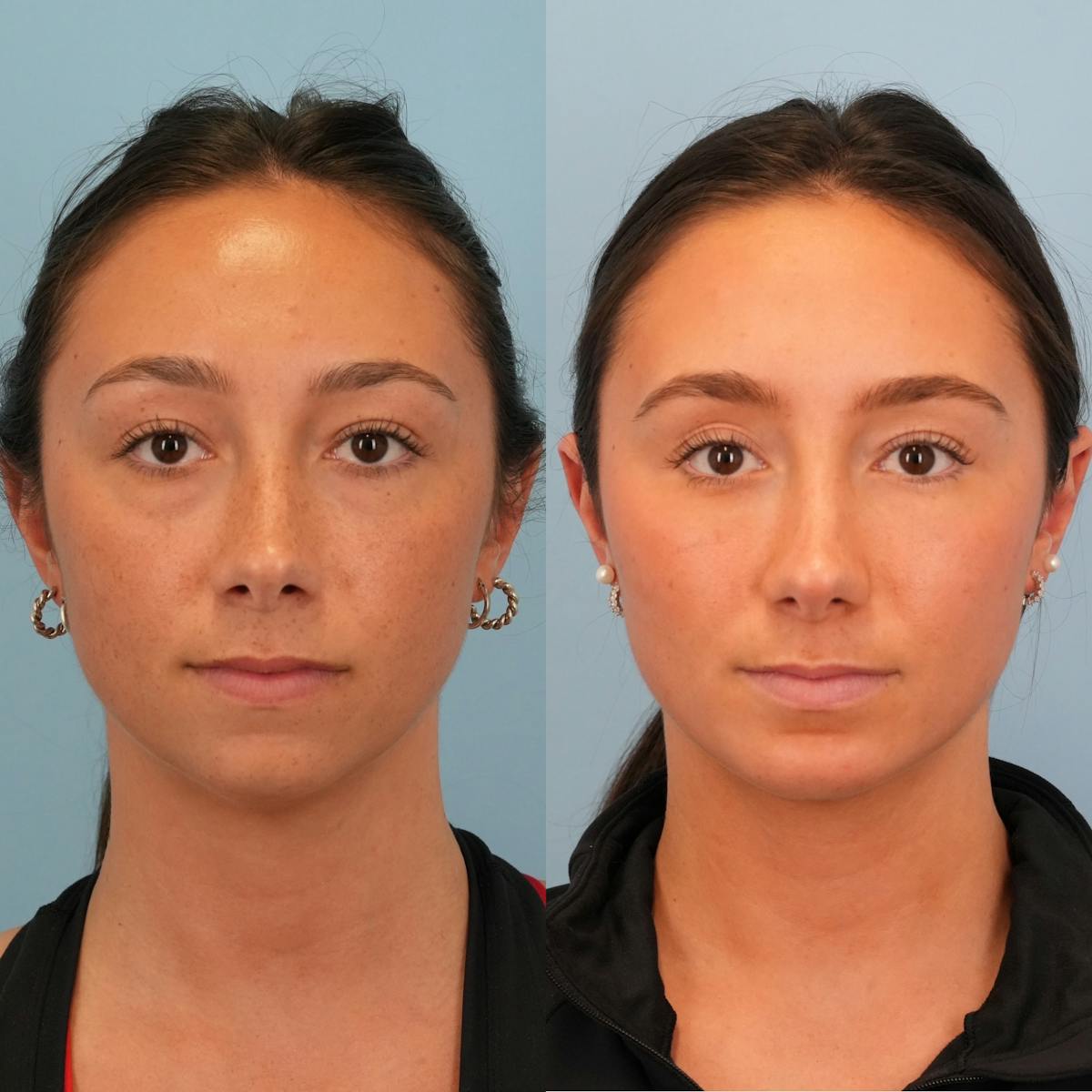 Blepharoplasty Before & After Gallery - Patient 133103 - Image 5