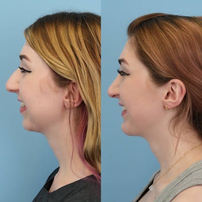Chin Implants Before & After Gallery - Patient 322723 - Image 1