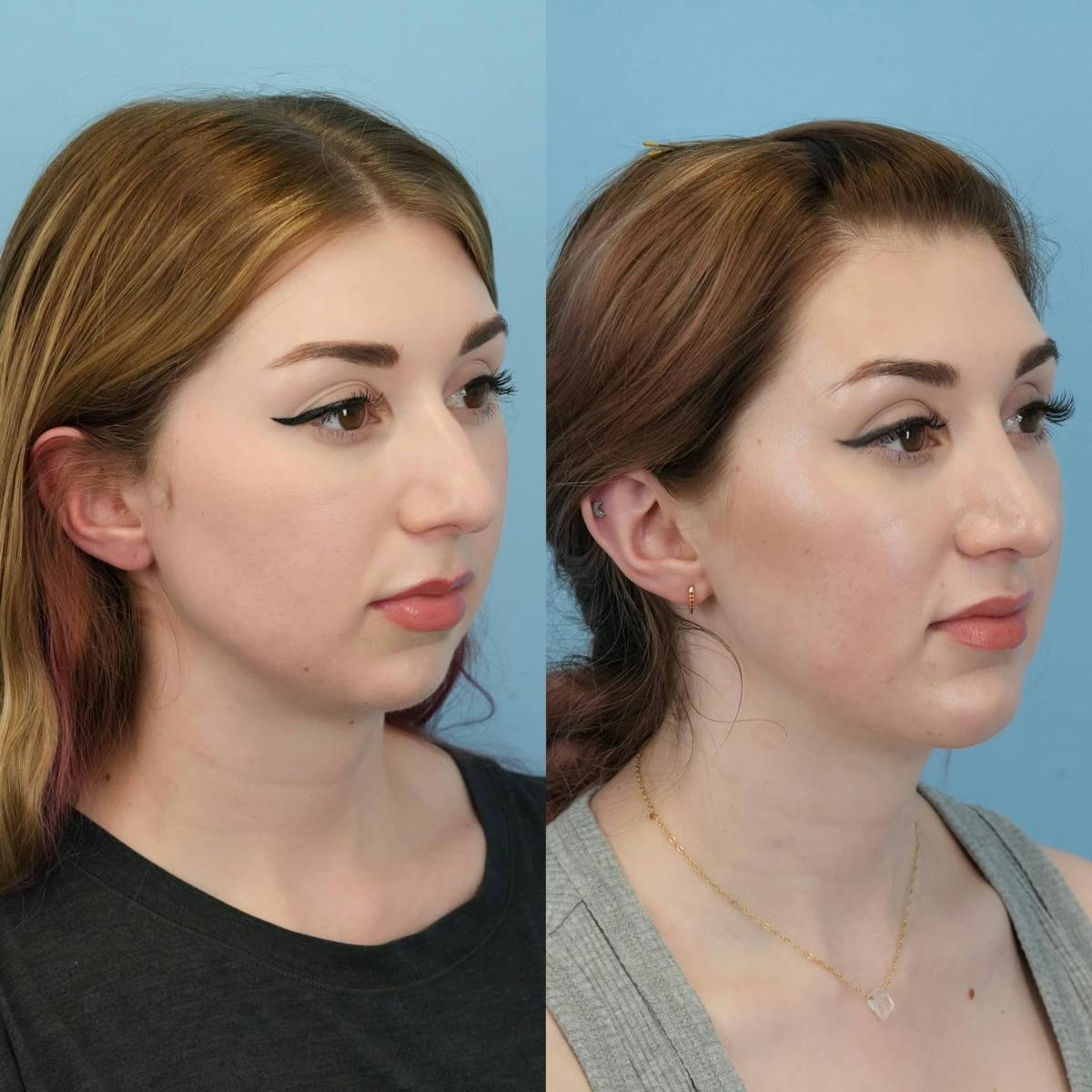 Chin Implants Before & After Gallery - Patient 322723 - Image 4