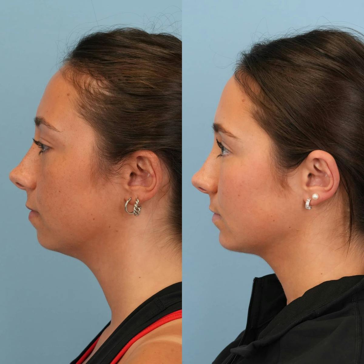 Chin Implants Before & After Gallery - Patient 370342 - Image 1
