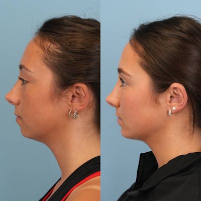 Chin Implants Before & After Gallery - Patient 370342 - Image 1