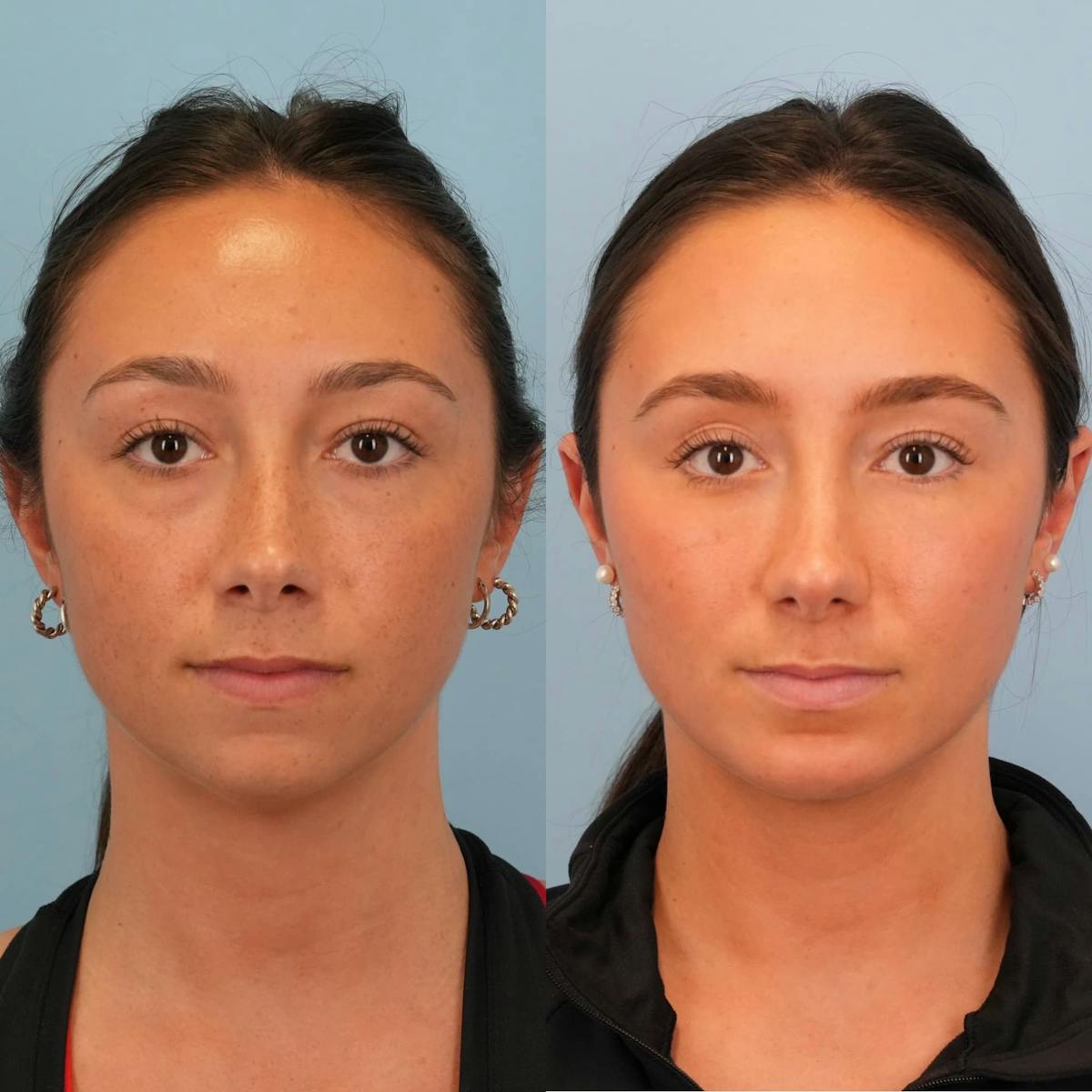 Chin Implants Before & After Gallery - Patient 370342 - Image 3