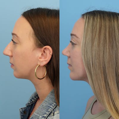 Chin Implants Before & After Gallery - Patient 187421 - Image 1