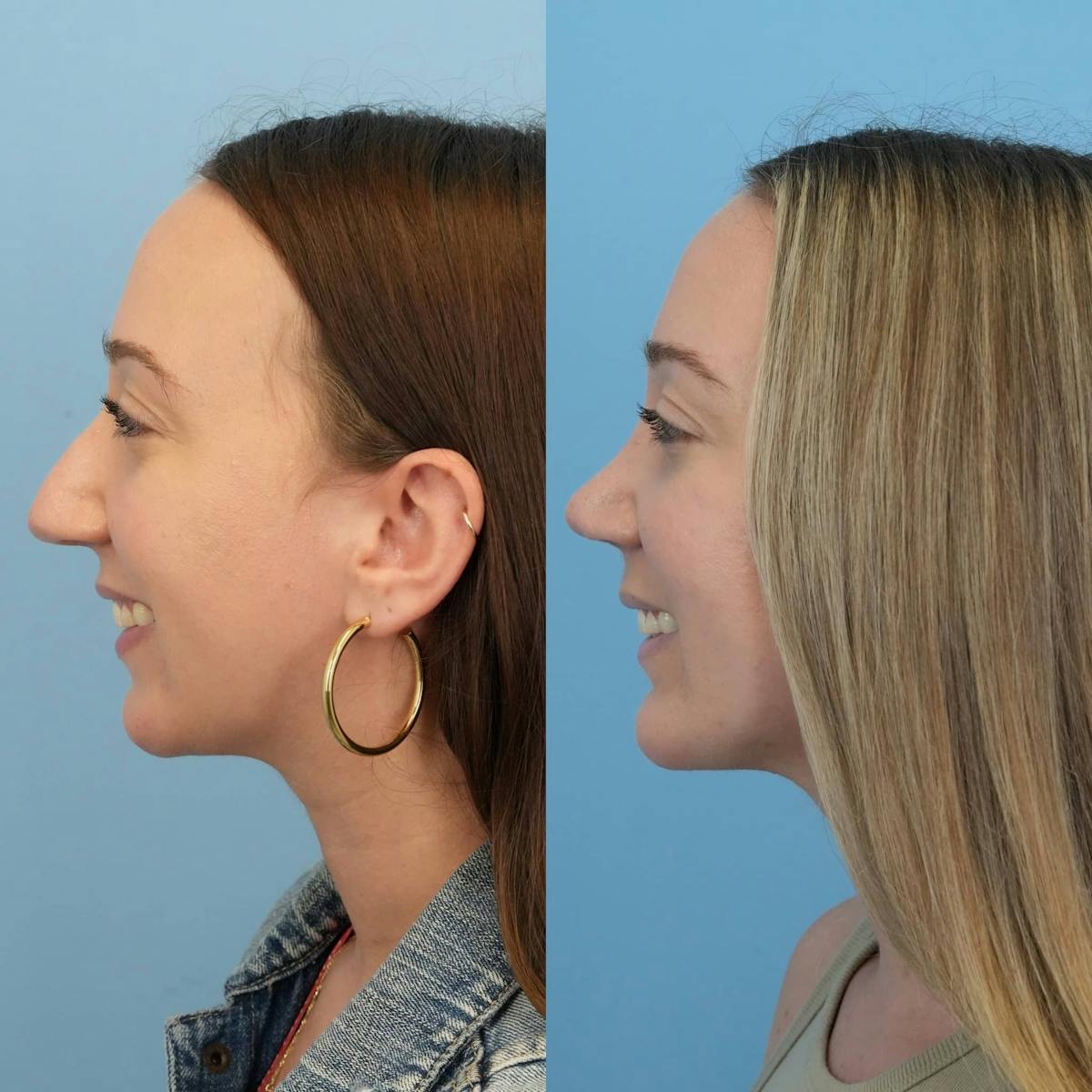 Chin Implants Before & After Gallery - Patient 187421 - Image 2