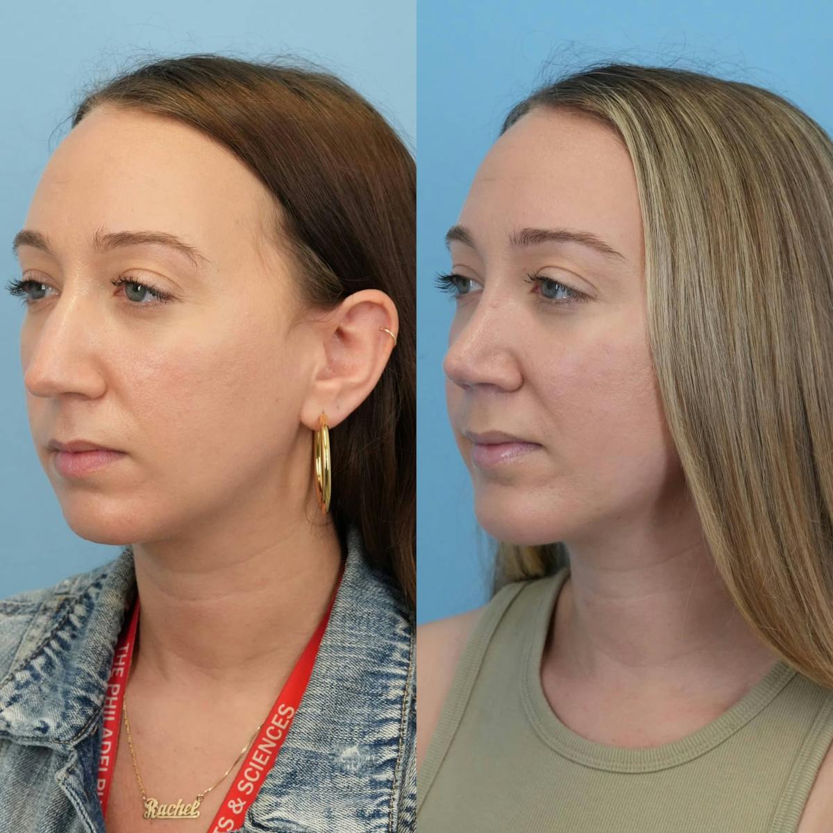 Chin Implants Before & After Gallery - Patient 187421 - Image 3
