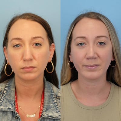 Rhinoplasty Before & After Gallery - Patient 263562 - Image 1