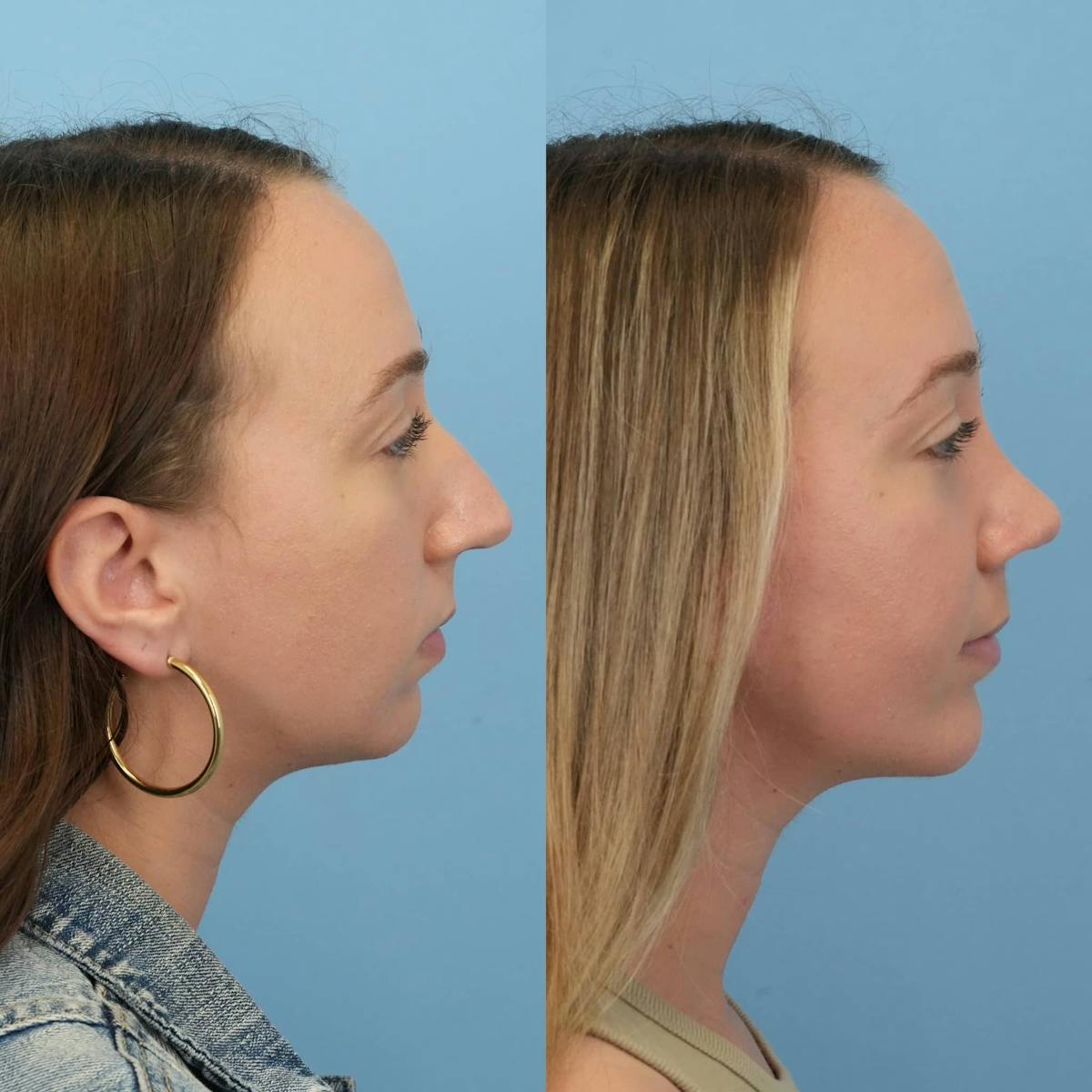 Chin Implants Before & After Gallery - Patient 187421 - Image 5