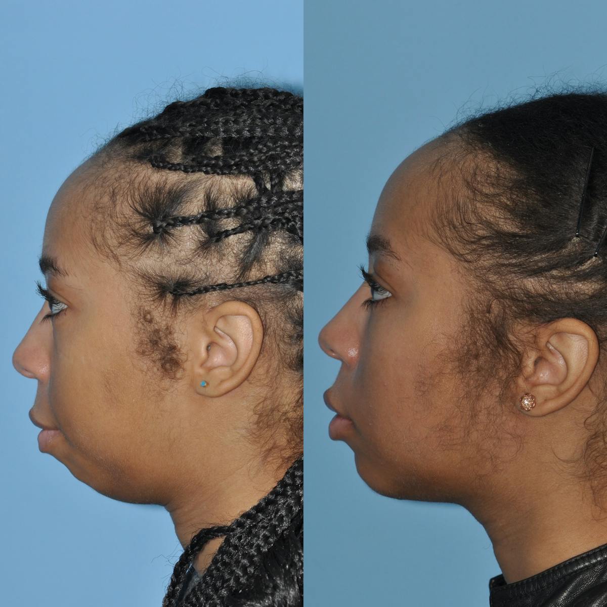Chin Implants Before & After Gallery - Patient 353650 - Image 1