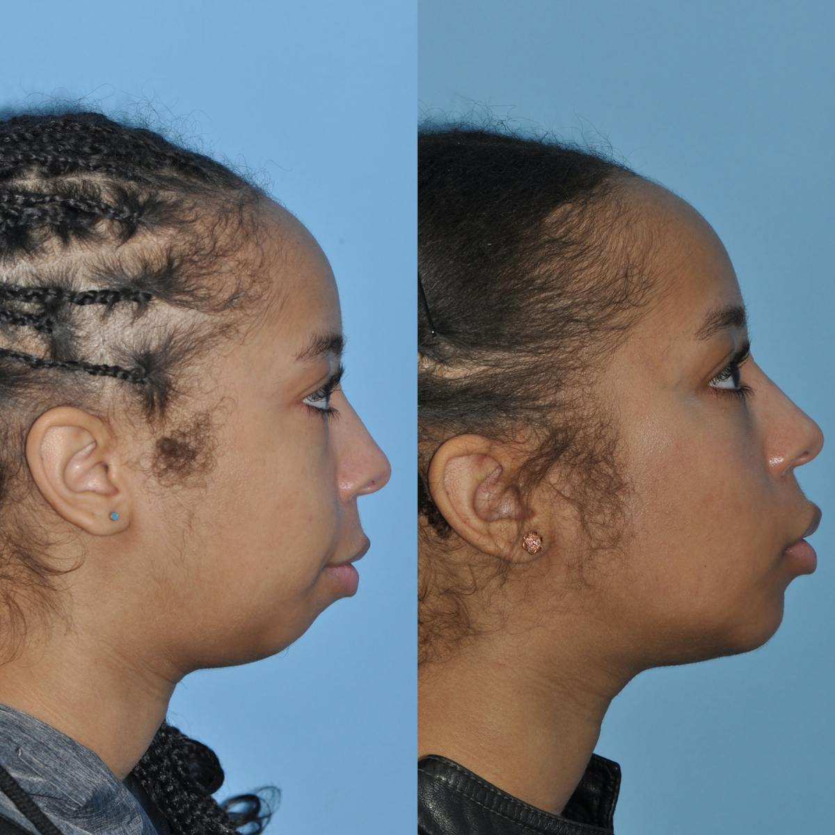 Chin Implants Before & After Gallery - Patient 353650 - Image 3