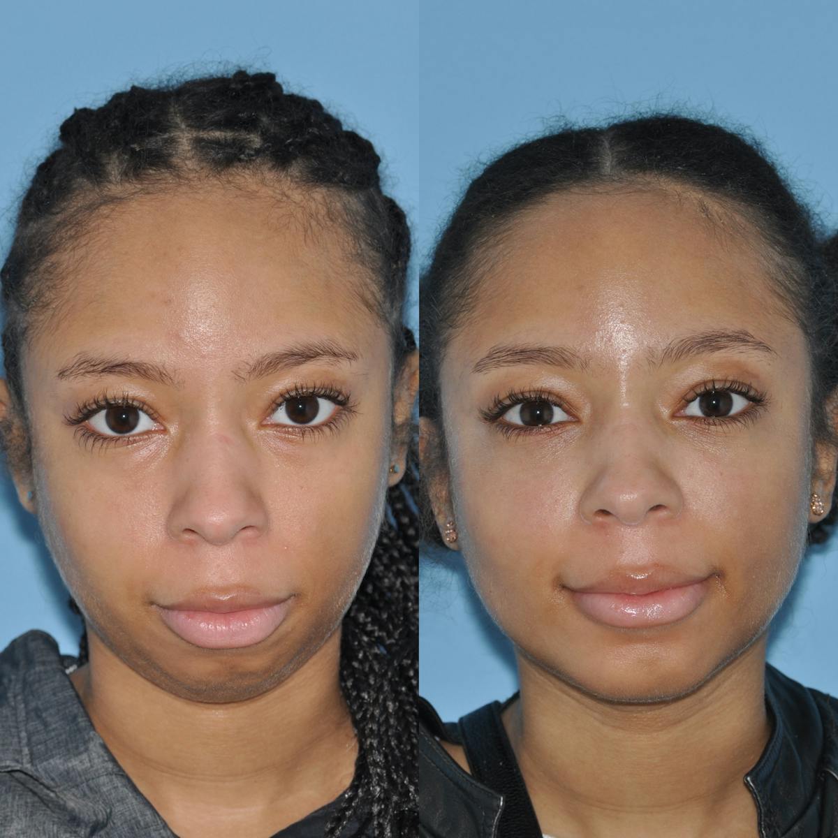 Chin Implants Before & After Gallery - Patient 353650 - Image 5