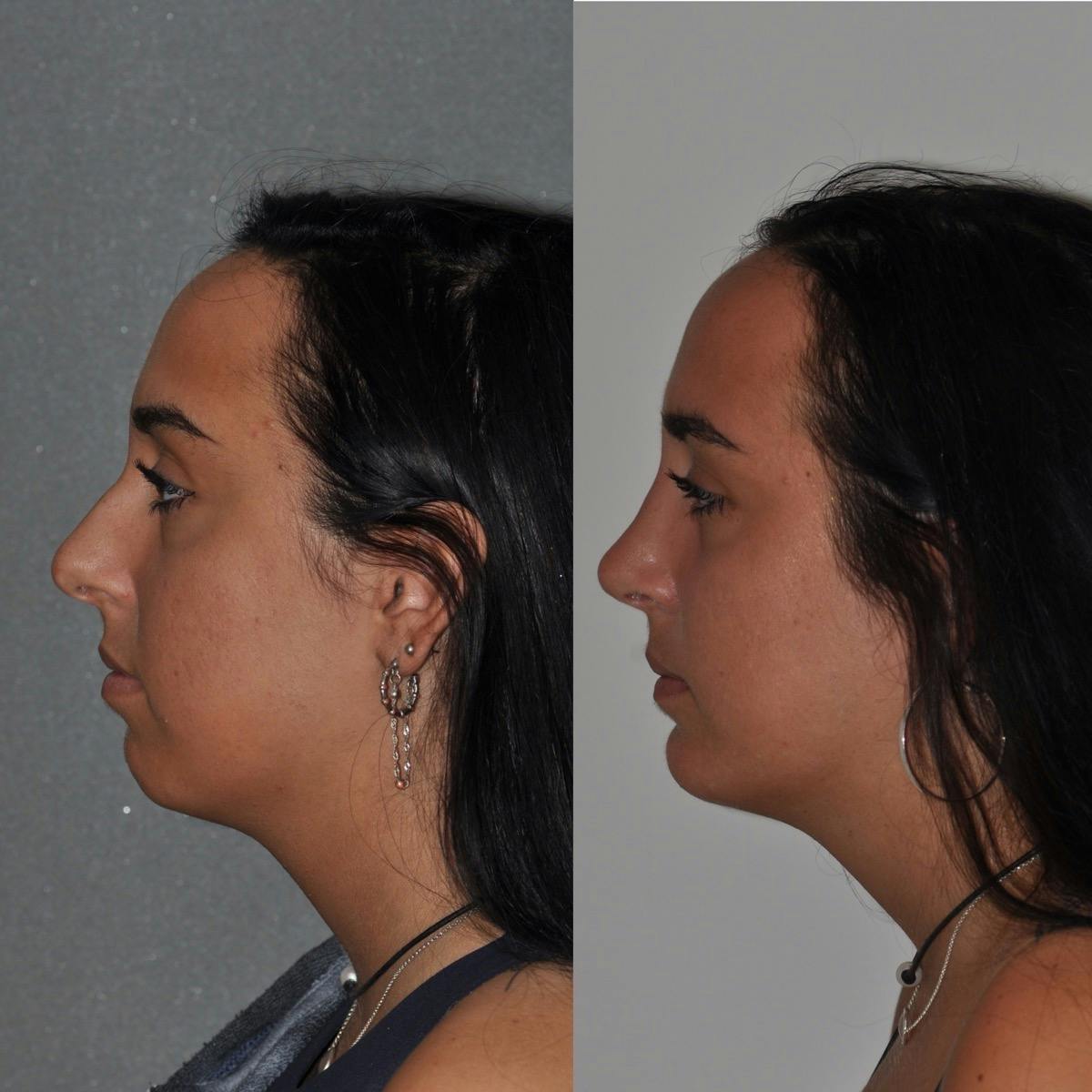 Chin Implants Before & After Gallery - Patient 251278 - Image 1