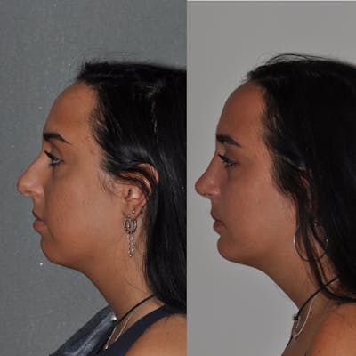 Chin Implants Before & After Gallery - Patient 251278 - Image 1