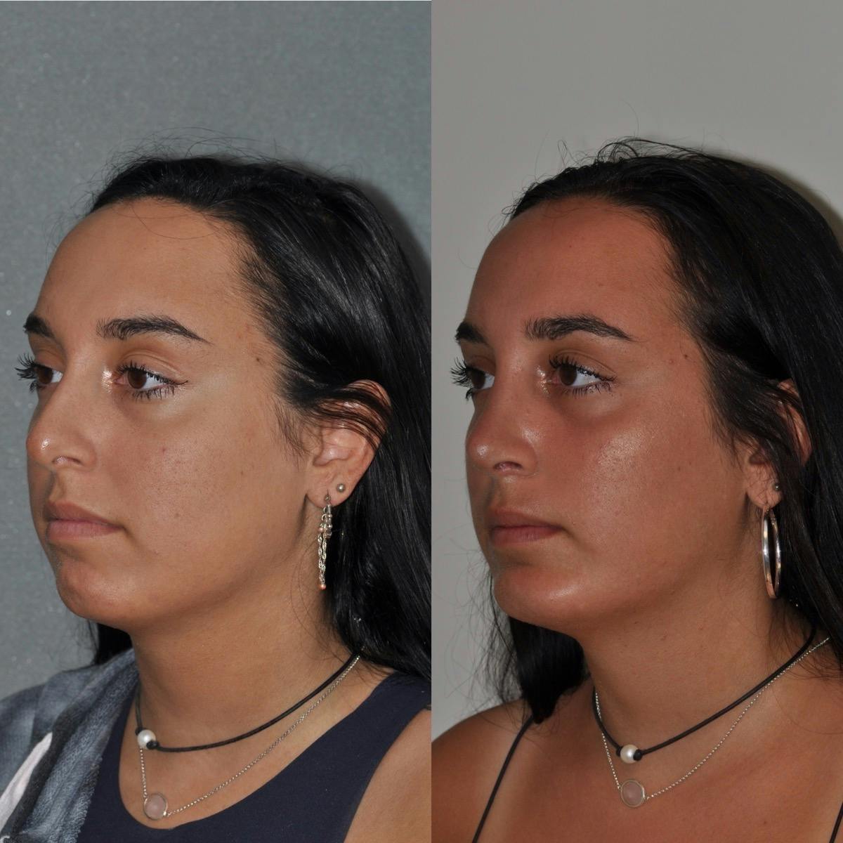 Chin Implants Before & After Gallery - Patient 251278 - Image 2
