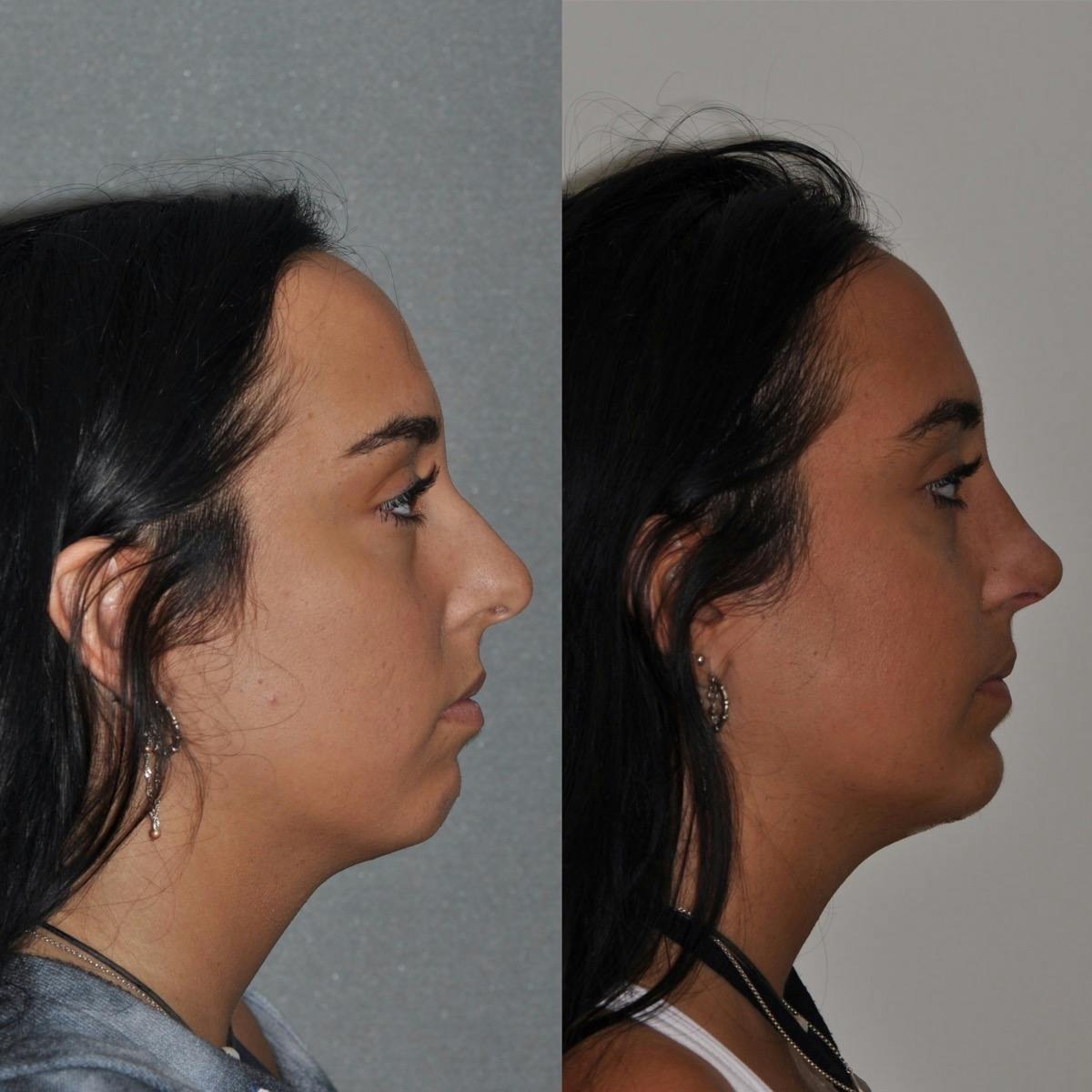 Chin Implants Before & After Gallery - Patient 251278 - Image 3