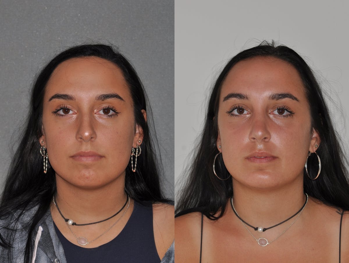 Chin Implants Before & After Gallery - Patient 251278 - Image 5