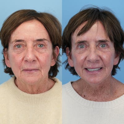 Facelift Before & After Gallery - Patient 420053 - Image 1