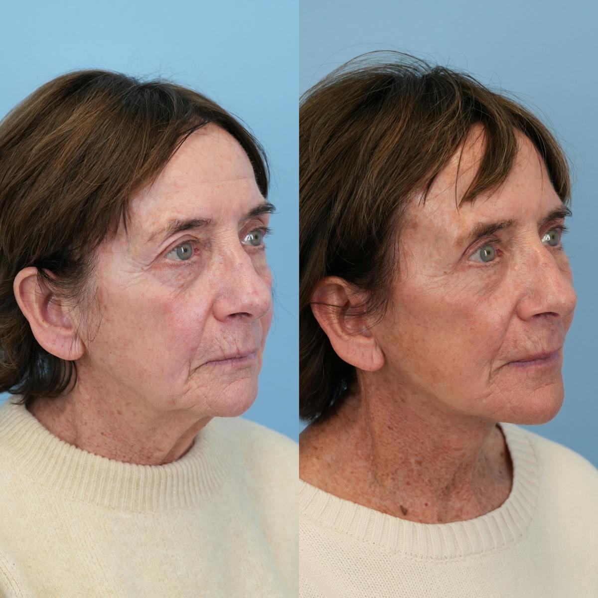 Facelift Before & After Gallery - Patient 420053 - Image 3
