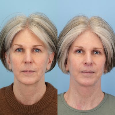 Lip Lift Before & After Gallery - Patient 419298 - Image 1