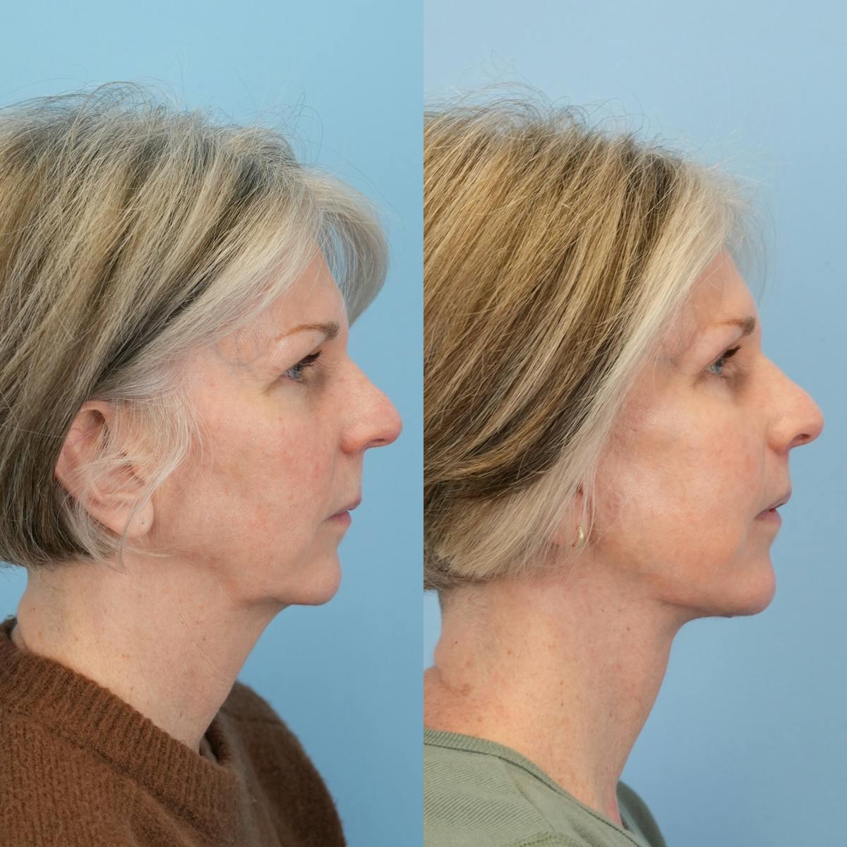 Lip Lift Before & After Gallery - Patient 419298 - Image 3