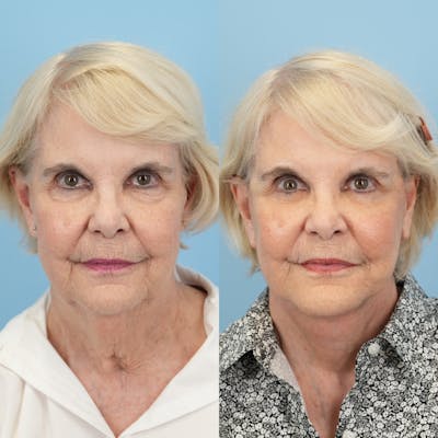 Facelift Before & After Gallery - Patient 328625 - Image 1