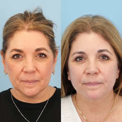 Facelift Before & After Gallery - Patient 422478 - Image 1