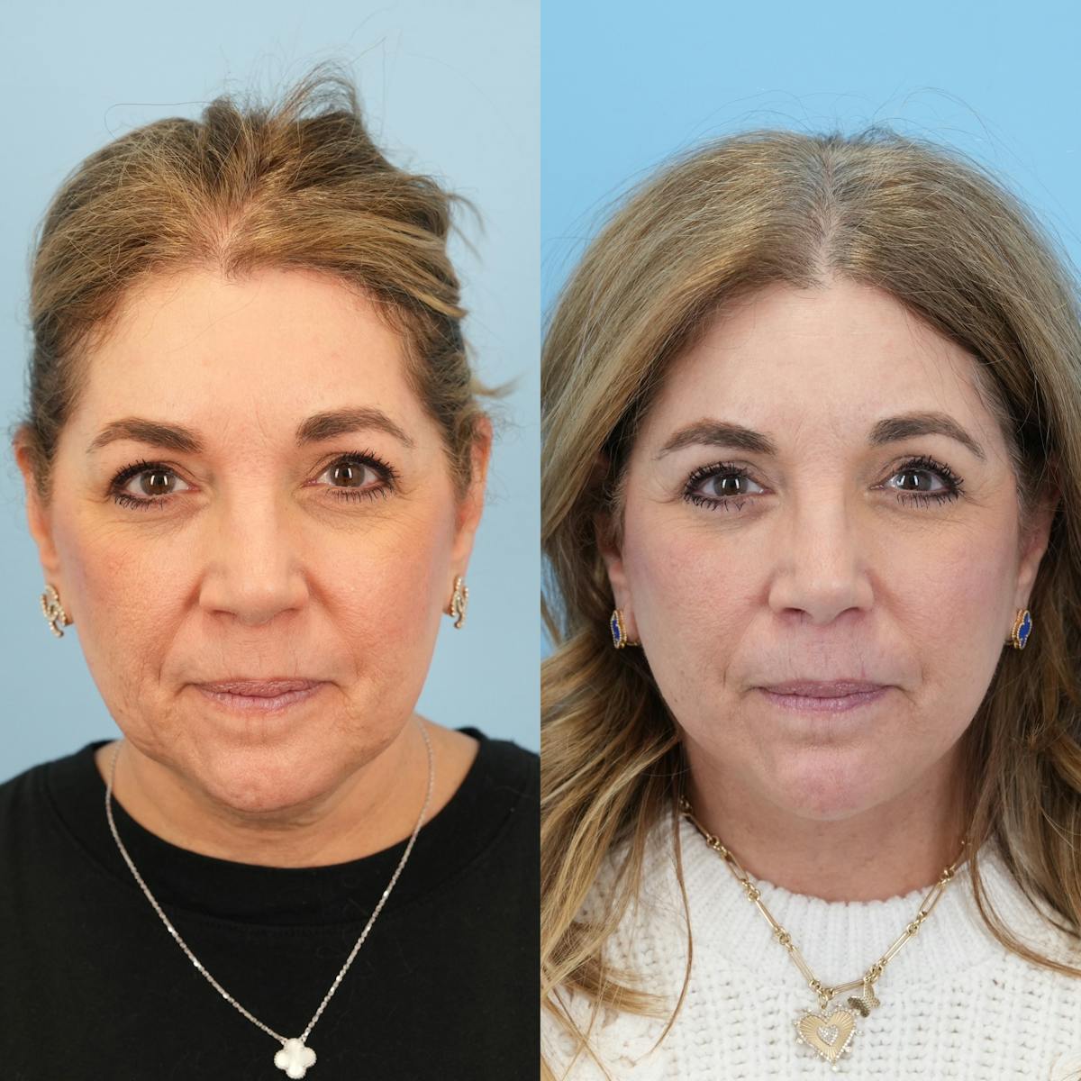 Facelift Before & After Gallery - Patient 422478 - Image 2