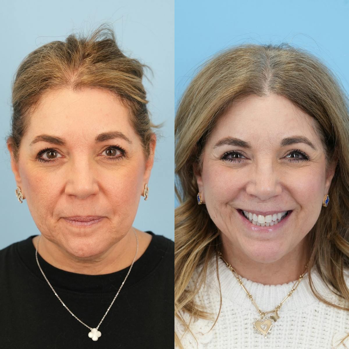 Facelift Before & After Gallery - Patient 422478 - Image 3