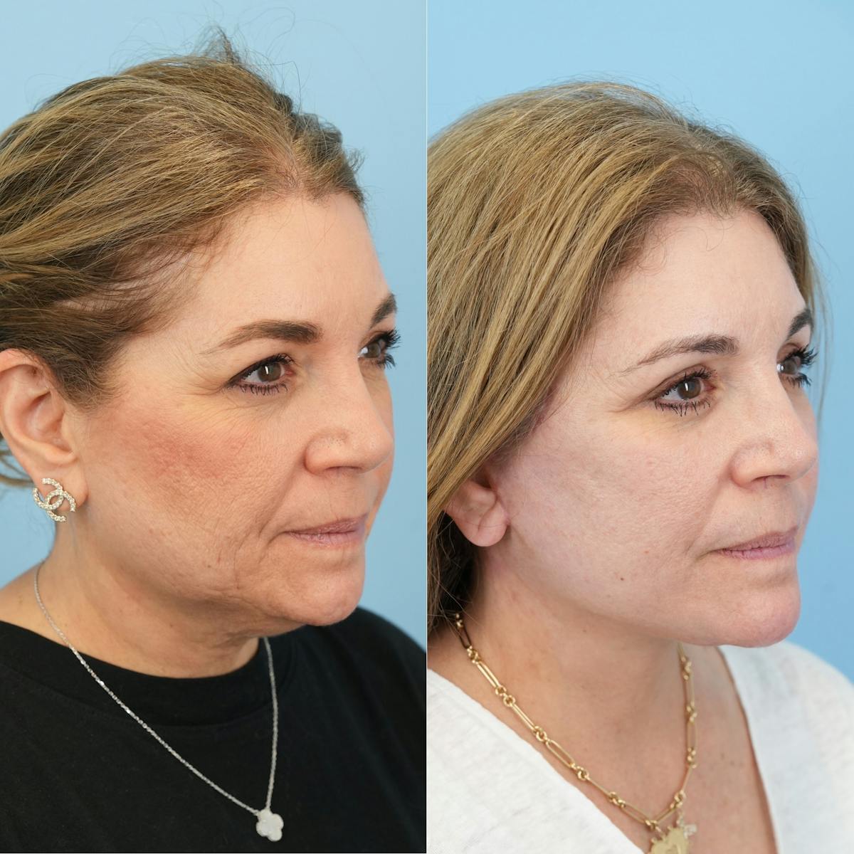 Facelift Before & After Gallery - Patient 422478 - Image 4