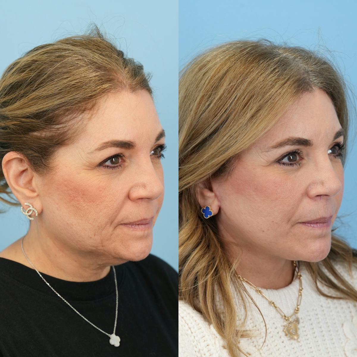 Facelift Before & After Gallery - Patient 422478 - Image 5
