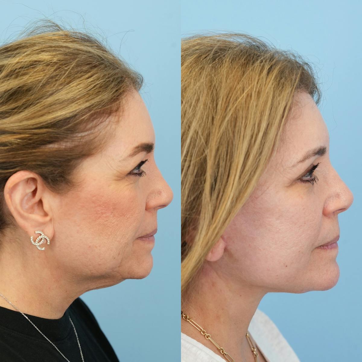 Facelift Before & After Gallery - Patient 422478 - Image 6