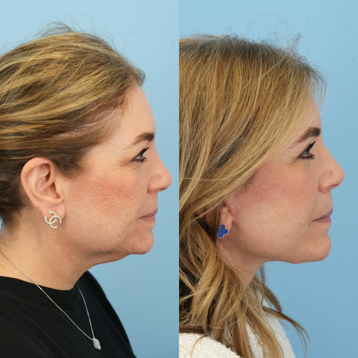 Facelift Before & After Gallery - Patient 422478 - Image 7